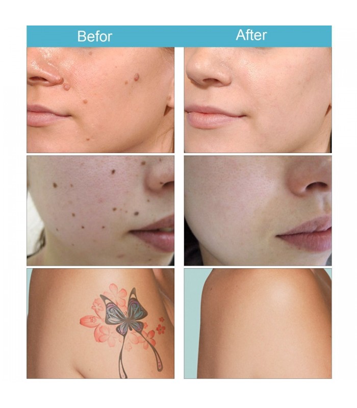 پک-سوزن-یکبار-مصرف-بیوتی-پن